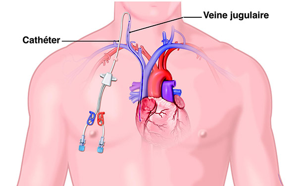 Abord vasculaire veineux central